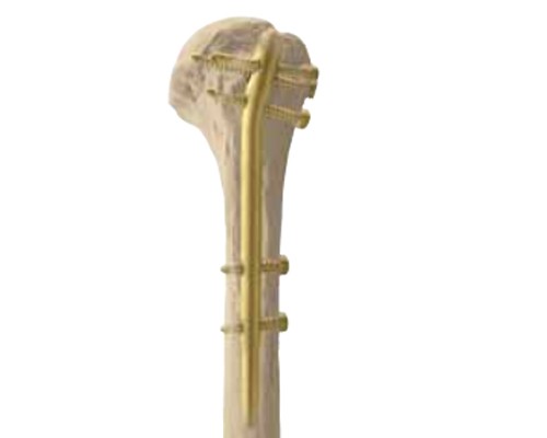 Humerus Intramedüller Çivi