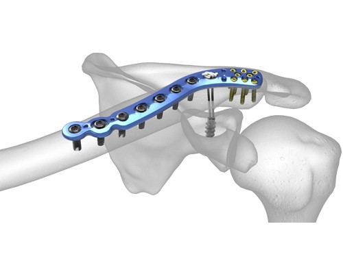 Clavucla Distal Plaklar