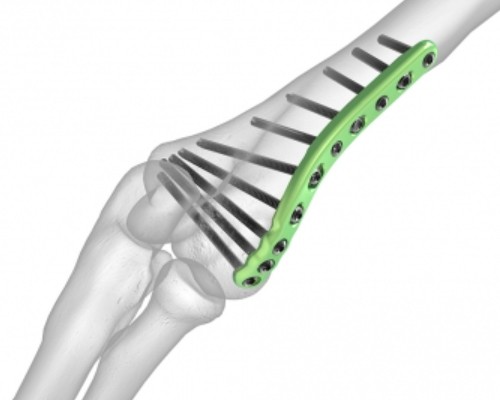 Humerus Distal Medial Plaklar