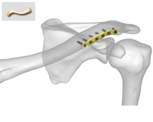 Clavucla Anterior Plaklar